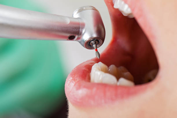 Best Emergency Tooth Extraction in Park Rapids, MN